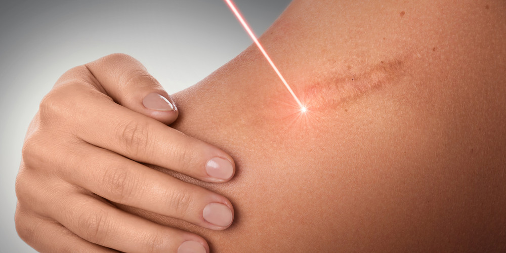 image36 chi phí trị sẹo lồi bằng laser
