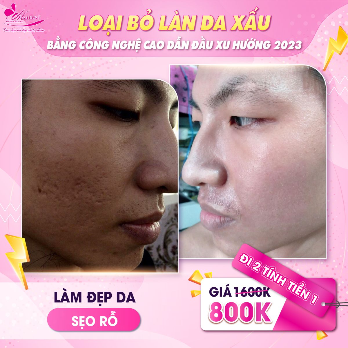 SĂN SALE KHỦNG - NHẬN QUÀ TO mừng ngày 8 tháng 3 tại Mailisa da sẹo rỗ