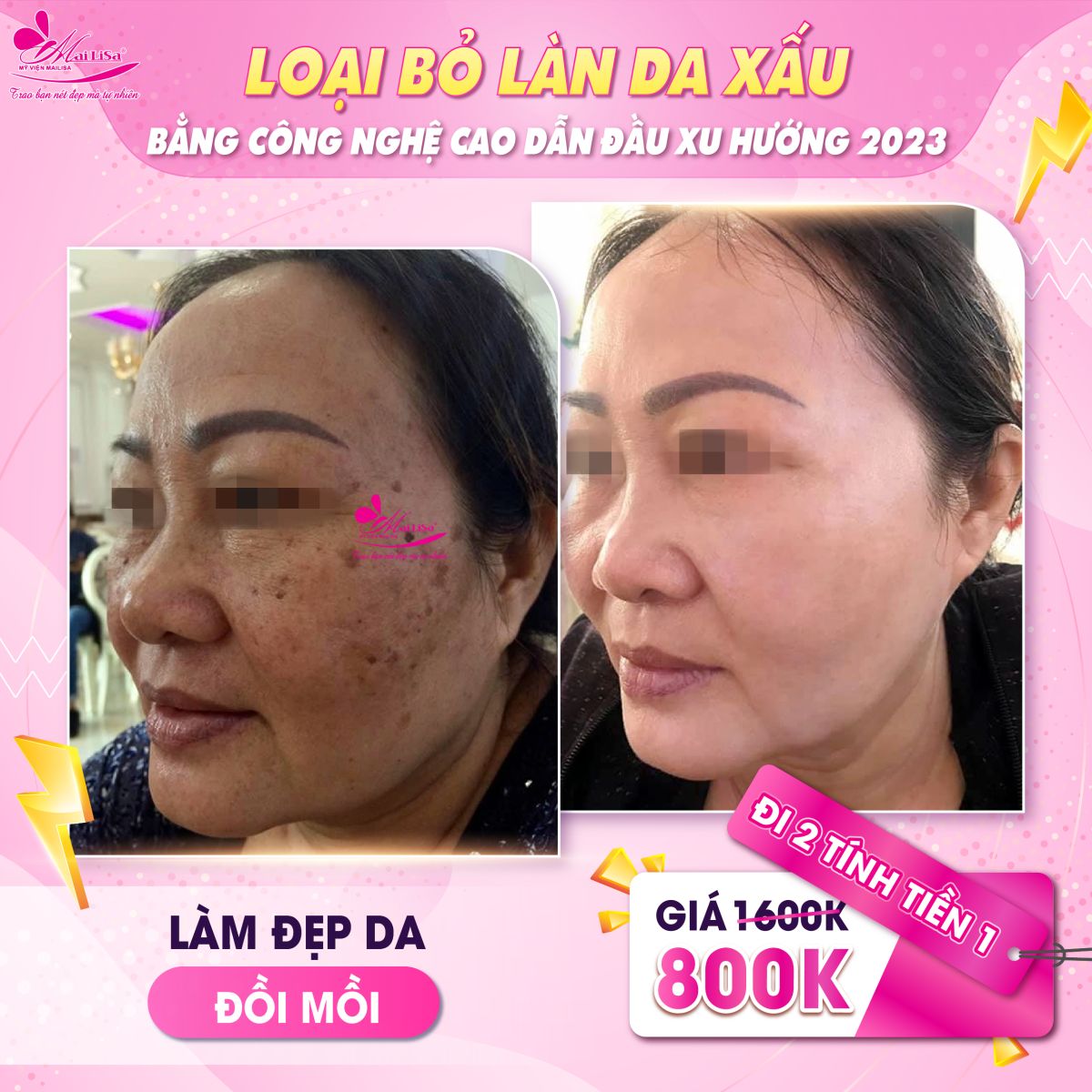 TUẦN LỄ VÀNG CHO LÀN DA XẤU - THÁNG 7 TUẦN LỄ VÀNG CHO LÀN DA XẤU - THÁNG 7