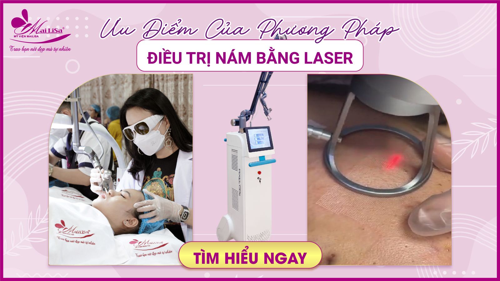 Bắn laser trị nám Whiteskin spectra có tốt không? Chi phí 2023 Ưu điểm của phương pháp điều trị nám bằng Laser