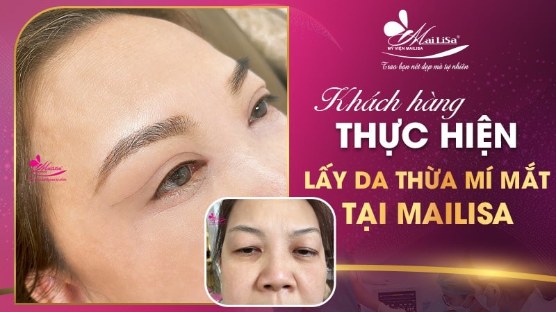 Có nên lấy mỡ mí mắt nội soi không và những điều cần tránh 15 - 15 lấy mỡ mí mắt nội soi lấy mỡ mí mắt nội soi