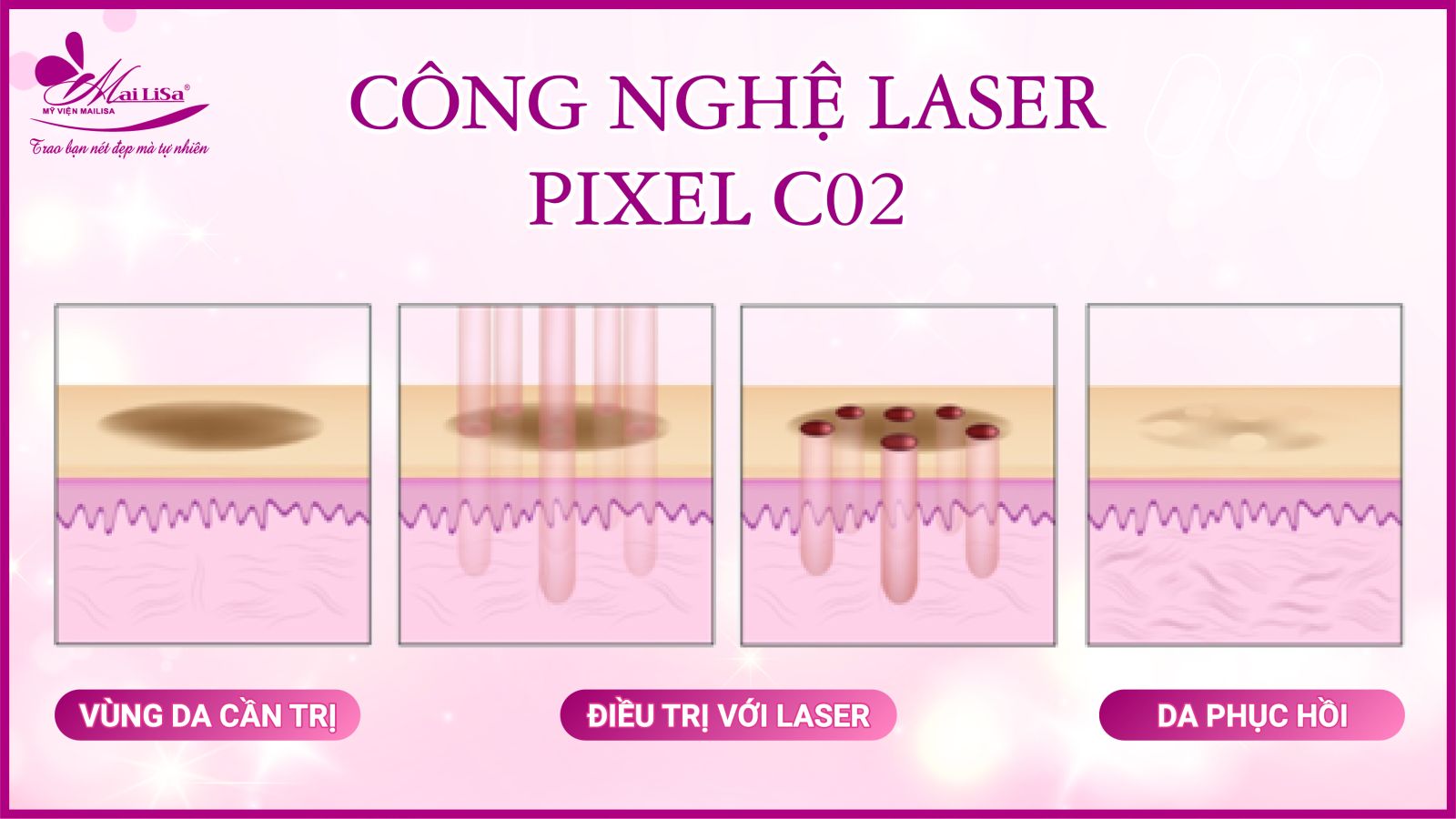 Bắn laser trị nám Whiteskin spectra có tốt không? Chi phí 2023 Bắn laser trị nám Whiteskin spectra có tốt không? Chi phí 2023