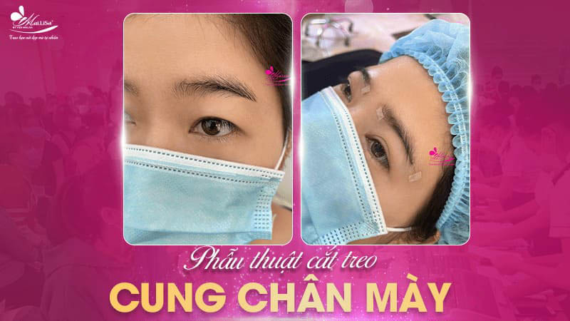 Treo chân mày là gì và có những phương pháp nào năm 2024 3 - 3 treo chân mày phau thuat cat treo cung chan may