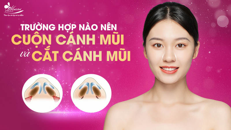 Cuốn cánh mũi bao nhiêu tiền? Bảng giá mới nhất 2024 7 - 7 cuốn cánh mũi bao nhiêu tiền phau thuat thu nho canh mui