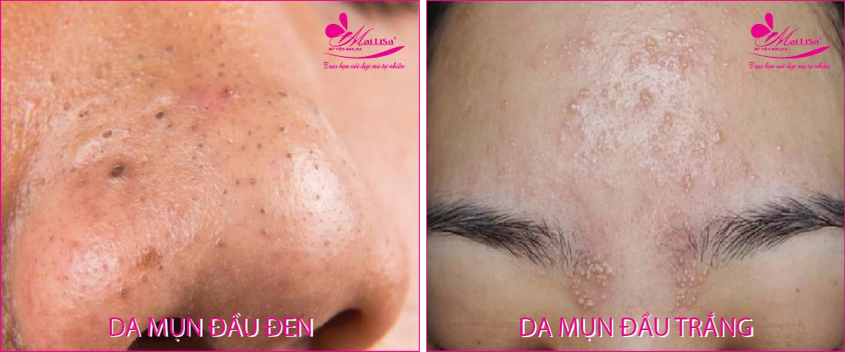 Làm đẹp da mụn thâm bằng công nghệ cao Làm đẹp da mụn thâm bằng công nghệ cao