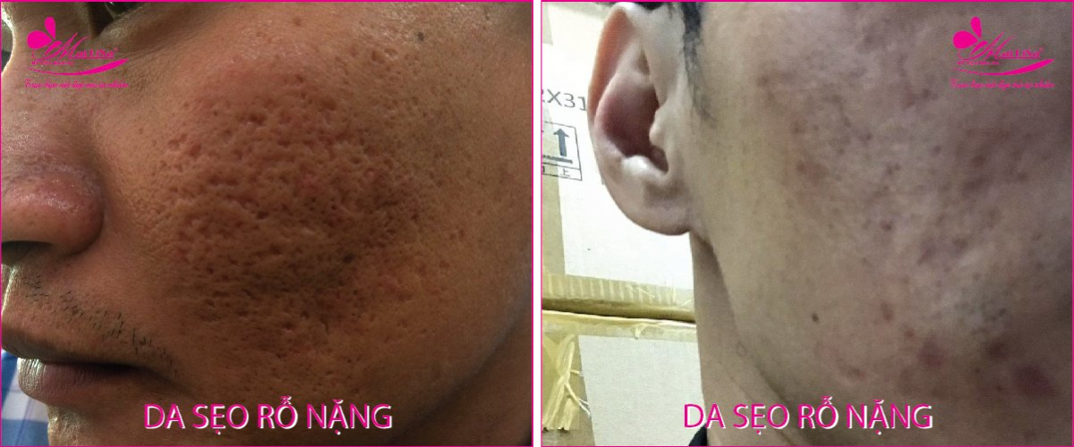 Làm đẹp da sẹo rỗ bằng công nghệ cao Làm đẹp da sẹo rỗ bằng công nghệ cao