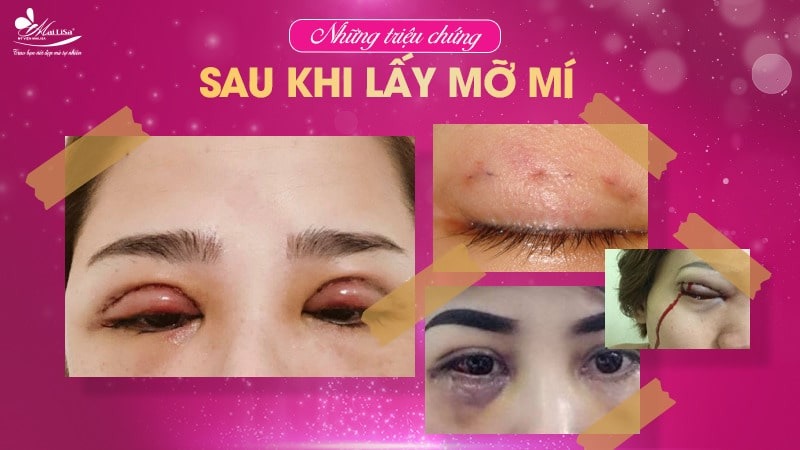 Lấy mỡ mí mắt trên bao nhiêu tiền? Dịch vụ ở đâu tốt 9 - 9 lấy mỡ mí mắt trên bao nhiêu tiền treo mi mat gia bao nhieu