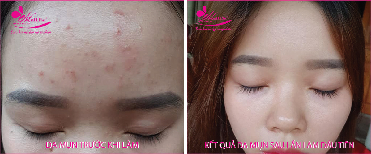Làm đẹp da mụn thâm bằng công nghệ cao Làm đẹp da mụn thâm bằng công nghệ cao