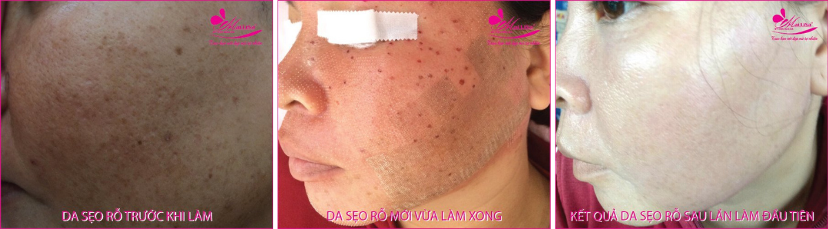 Làm đẹp da sẹo rỗ bằng công nghệ cao Làm đẹp da sẹo rỗ bằng công nghệ cao