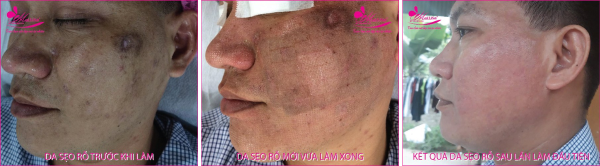 Làm đẹp da sẹo rỗ bằng công nghệ cao Làm đẹp da sẹo rỗ bằng công nghệ cao
