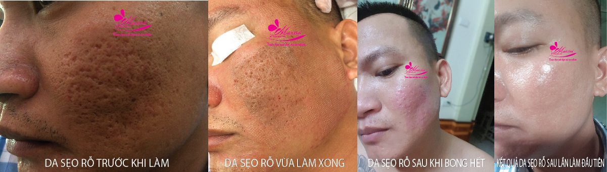 Làm đẹp da sẹo rỗ bằng công nghệ cao Làm đẹp da sẹo rỗ bằng công nghệ cao